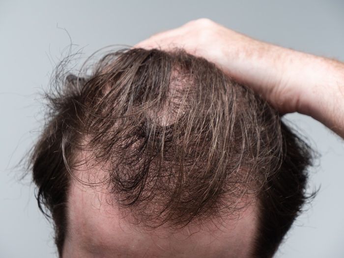 Close up of a young man holding his hair back showing clear signs of a receding hairline