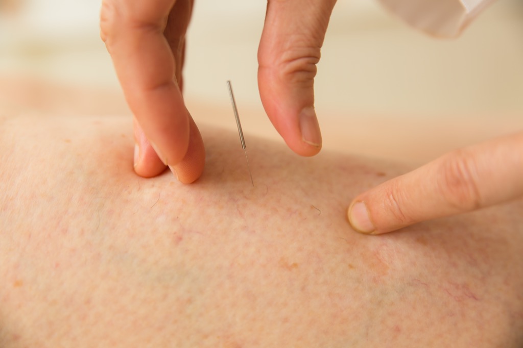 pins and needles, acupuncture, look younger
