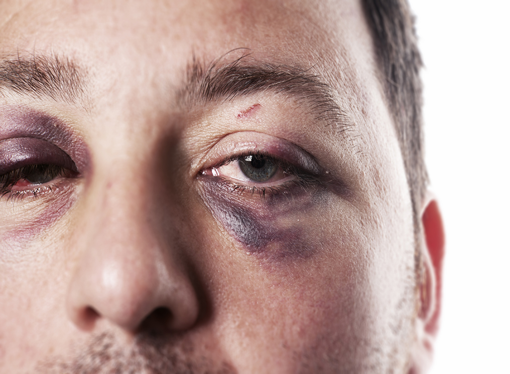 Black eye, 40s, what to give up in your 40s
