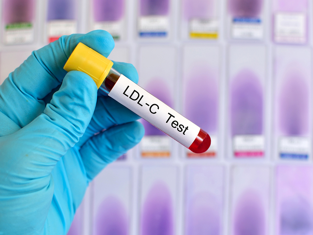 an LDL cholesterol test
