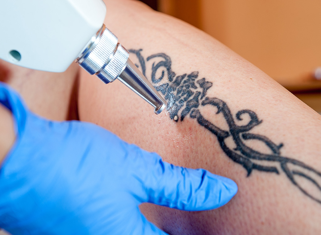 Tattoo, tattoo removal, 40s, what to give up in your 40s