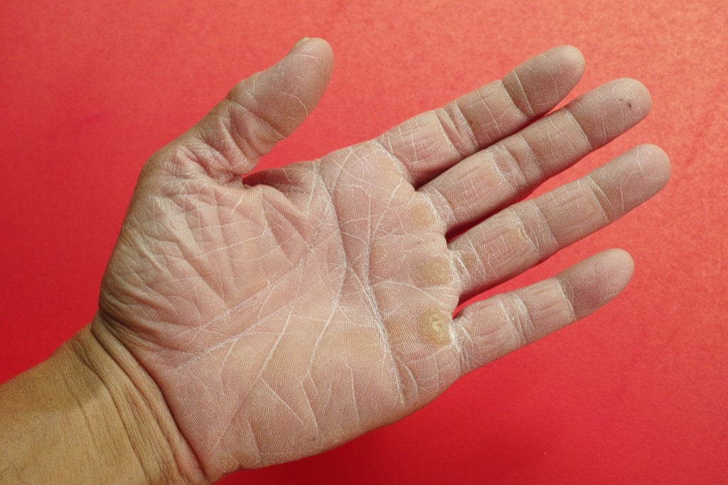 dry skin hands