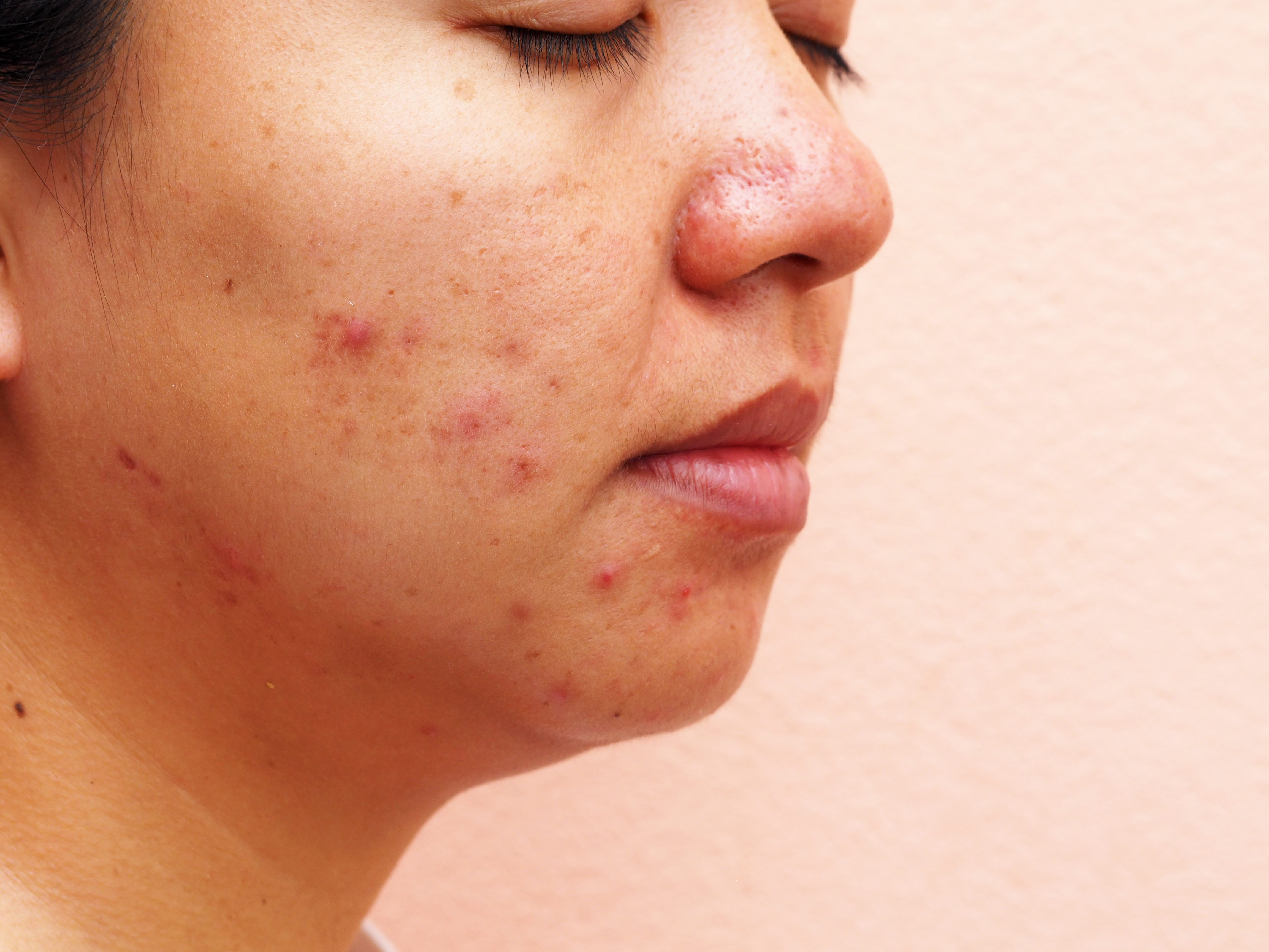 woman with acne healthy skin
