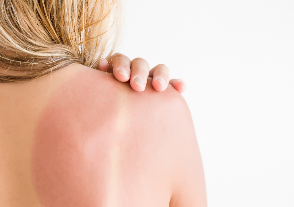 Woman with Sun Burn Summer Summer Health Mistakes 