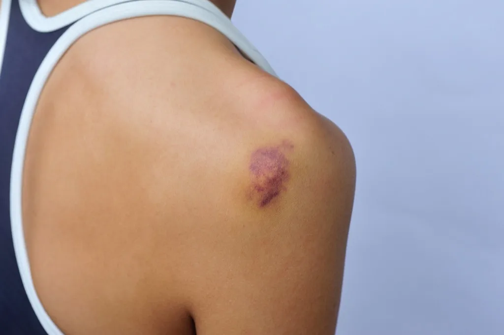 woman bruise liver function
