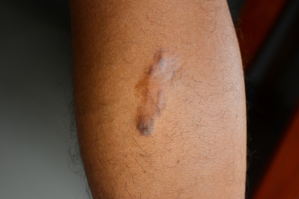 brown scar skin cancer symptoms 
