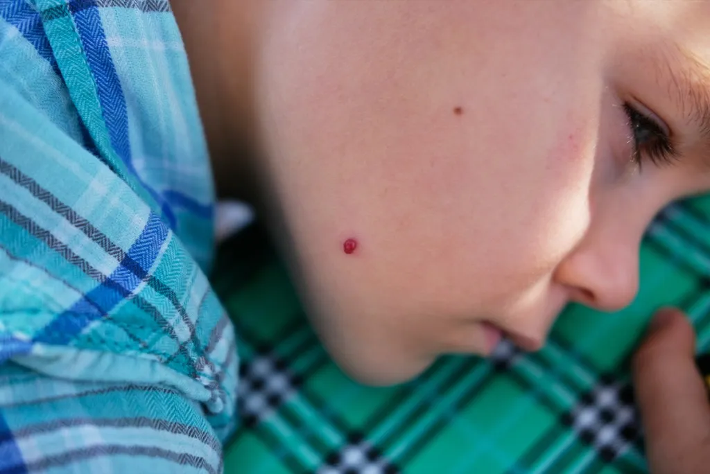 child with red mole skin cancer symptoms 