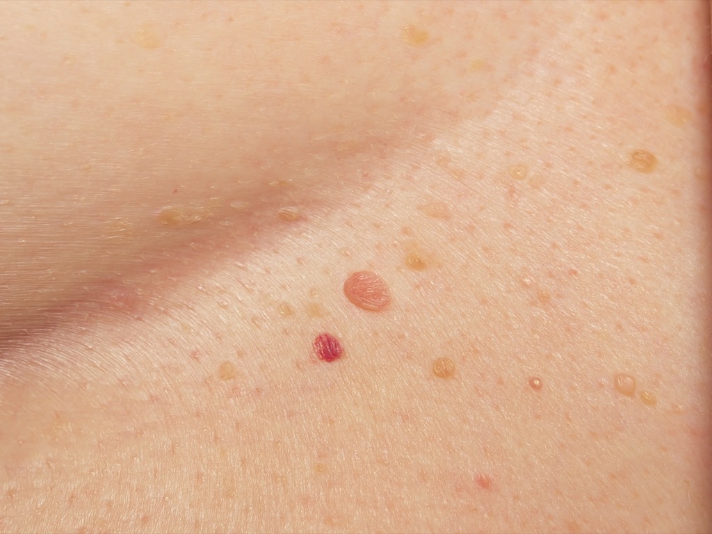 warts on skin skin cancer symptoms 