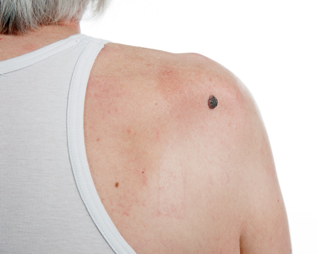 irregular mole Skin Cancer Symptoms