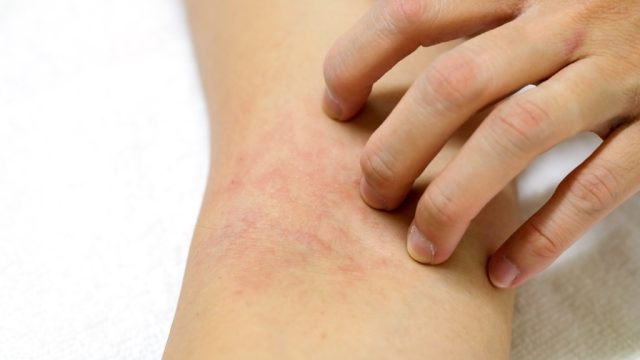 woman scratching rash on arm, signs your cold is serious