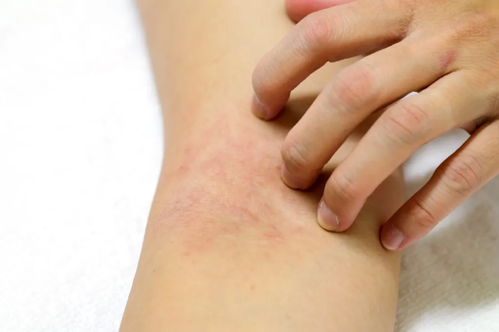 Rash on the Arm {Allergy Symptoms}