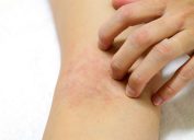 woman scratching rash on arm, signs your cold is serious
