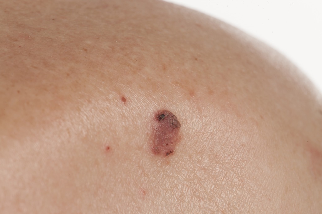 squamous cell carcinoma skin cancer symptoms 