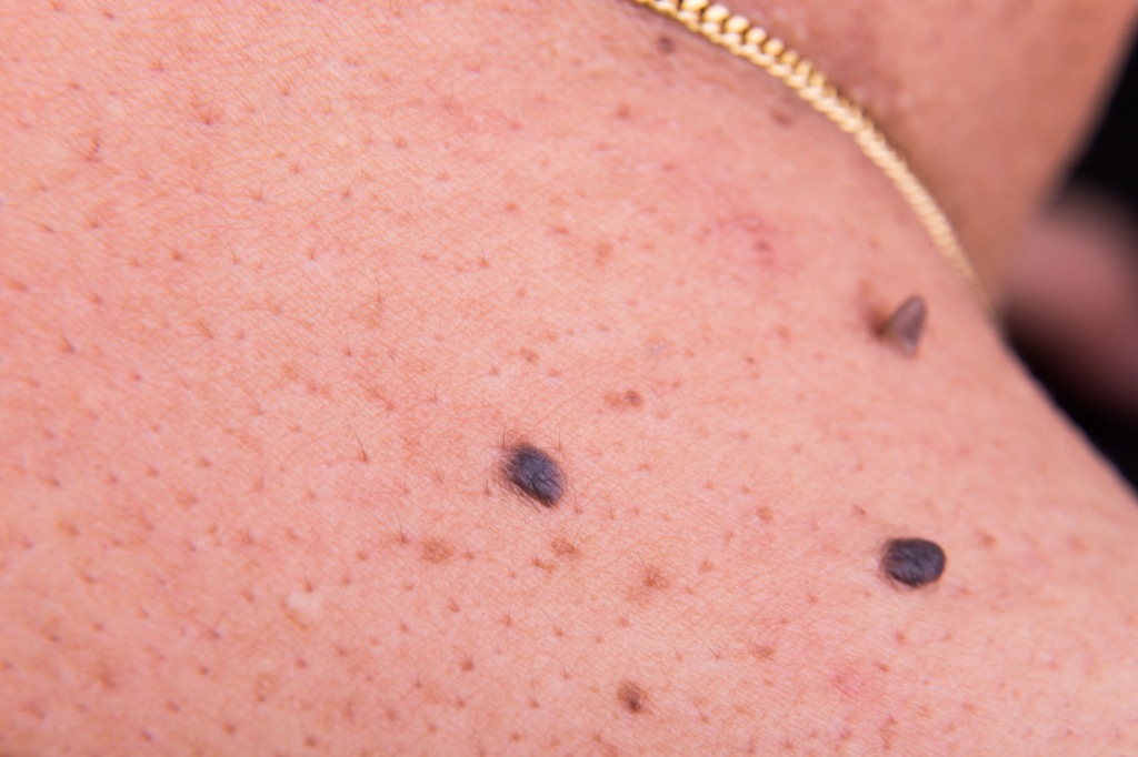 MULTIPLE MOLES skin cancer symptoms 