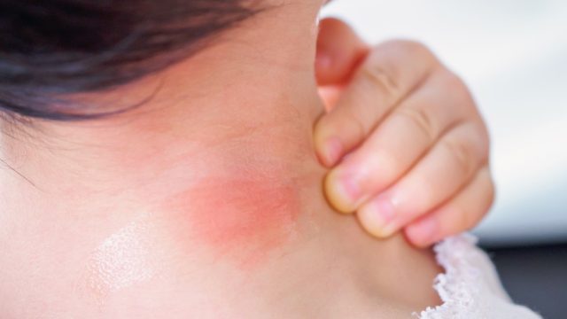 Red swollen bug bite allergic reaction