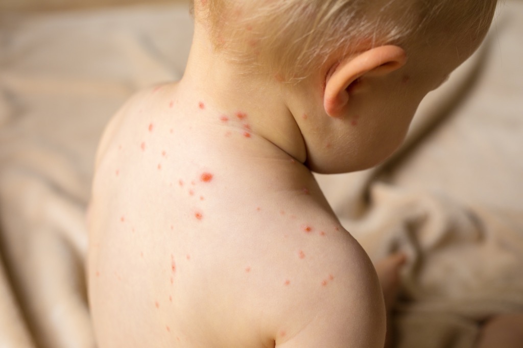 Baby with chicken pox