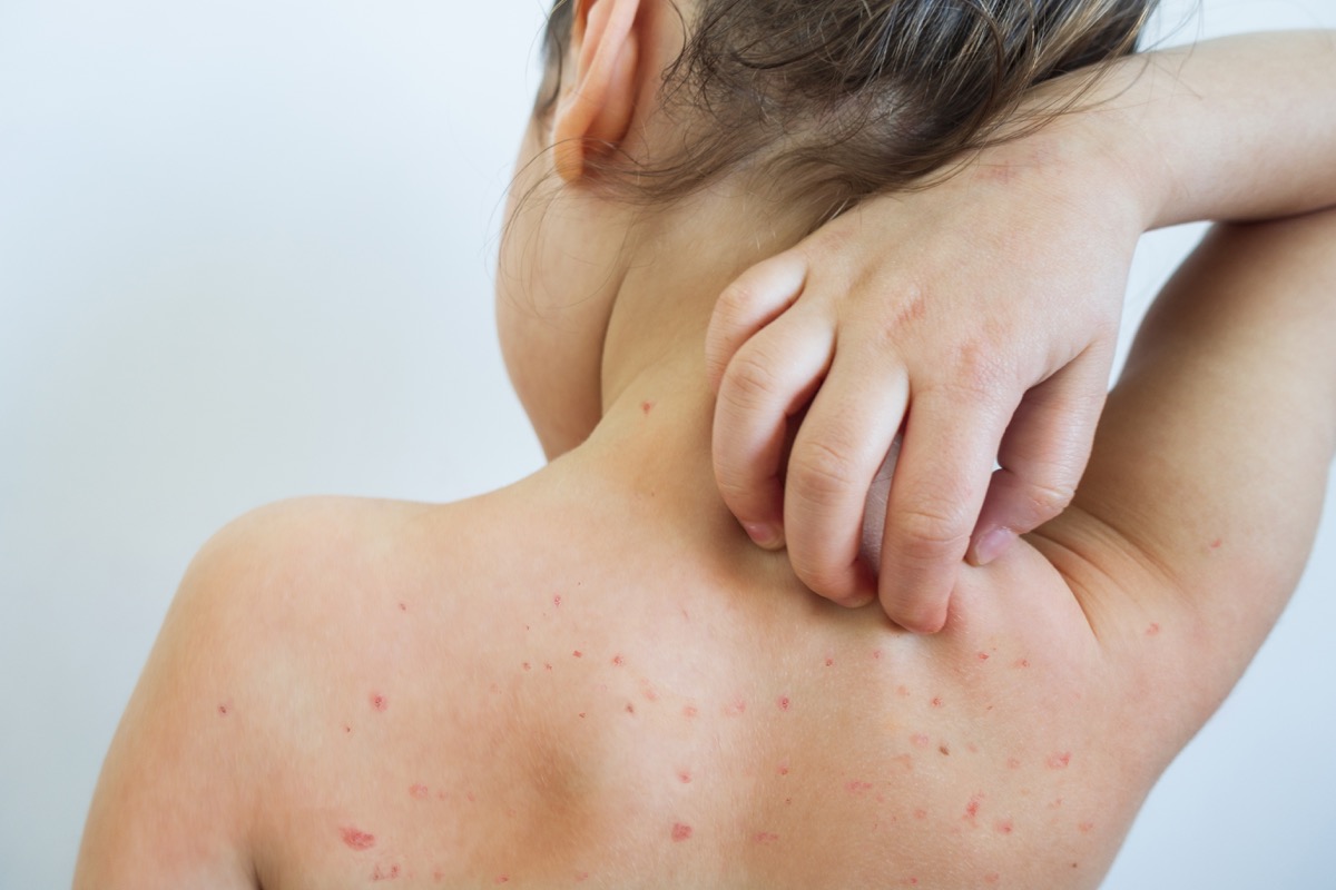 young girl with chickenpox scratching her back