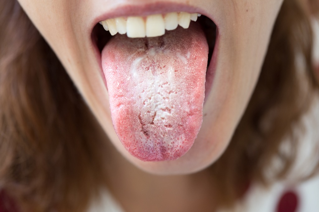 Oral thrush tongue