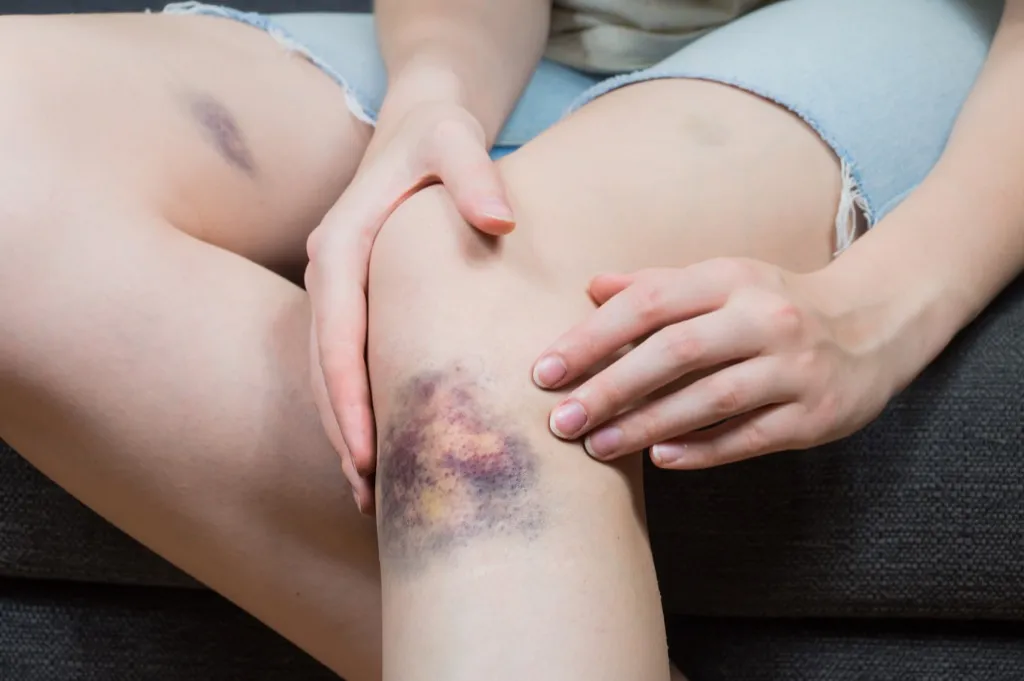 Woman with a Bruise