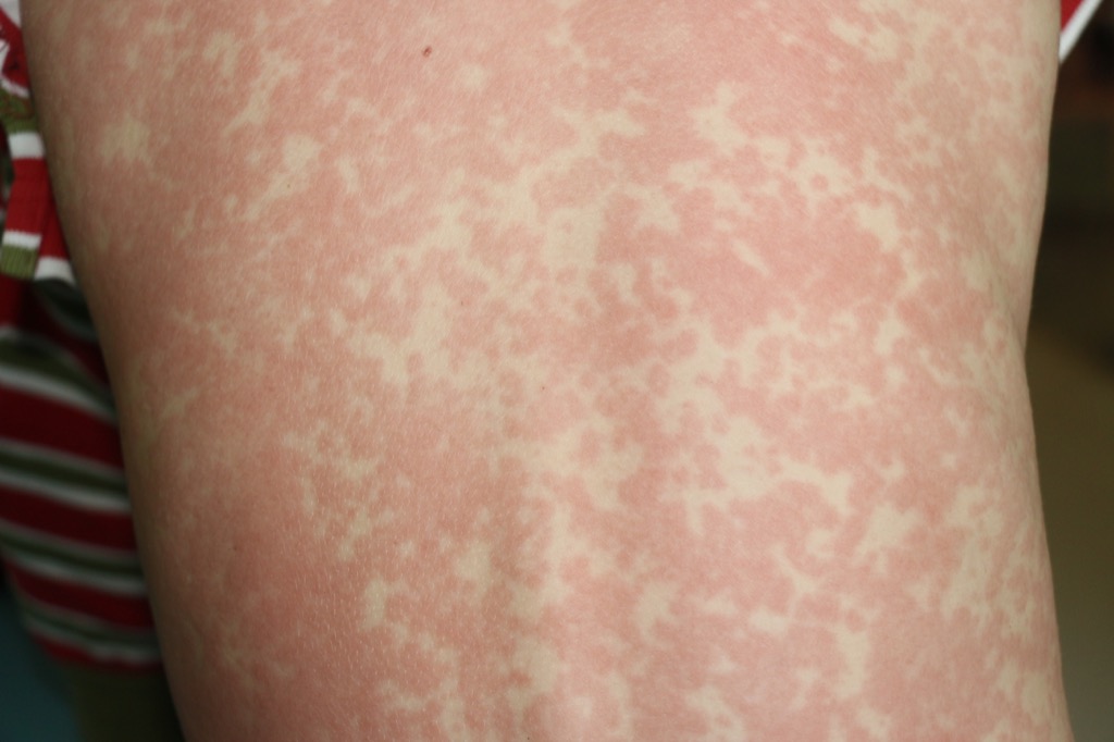 Person with a rash from the measles, scariest diseases