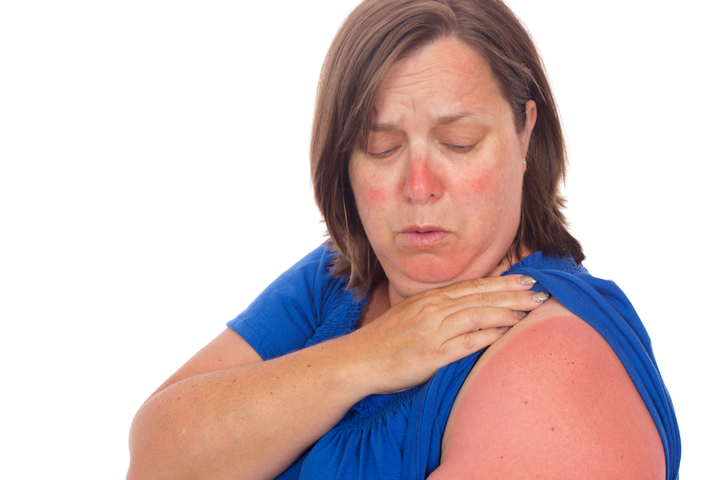 woman with a sunburn, most common injuries over 50