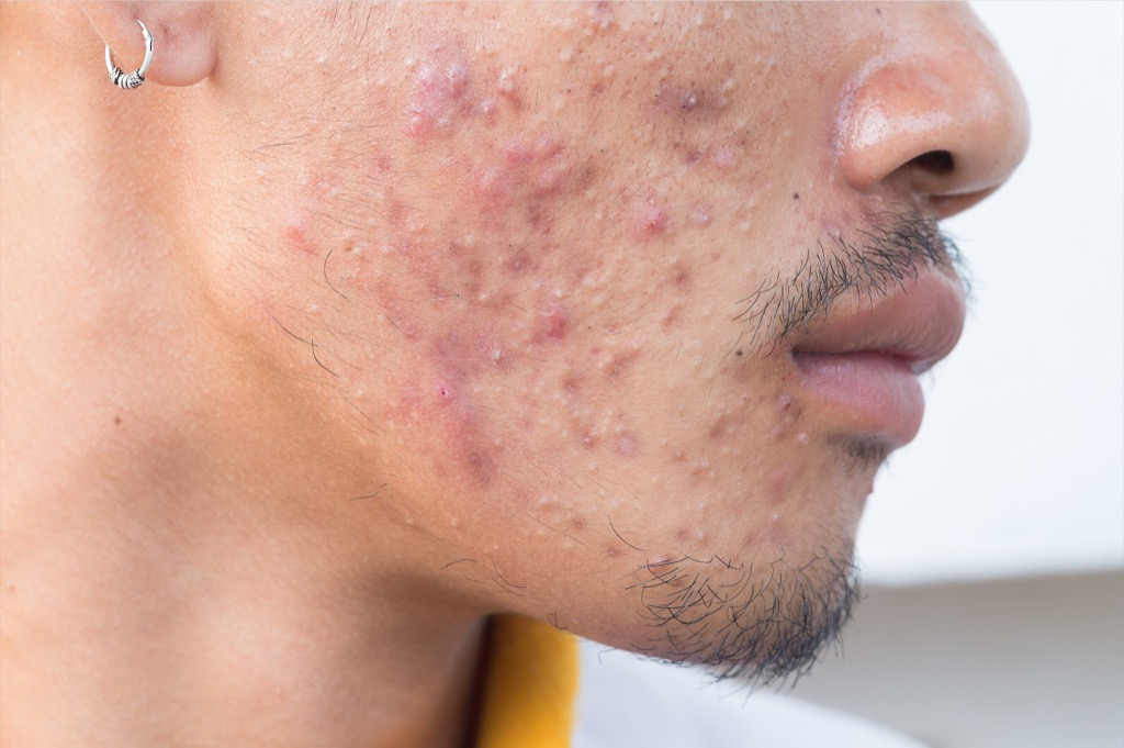 man with acne
