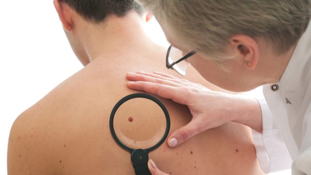 Skin Cancer, skin cancer facts