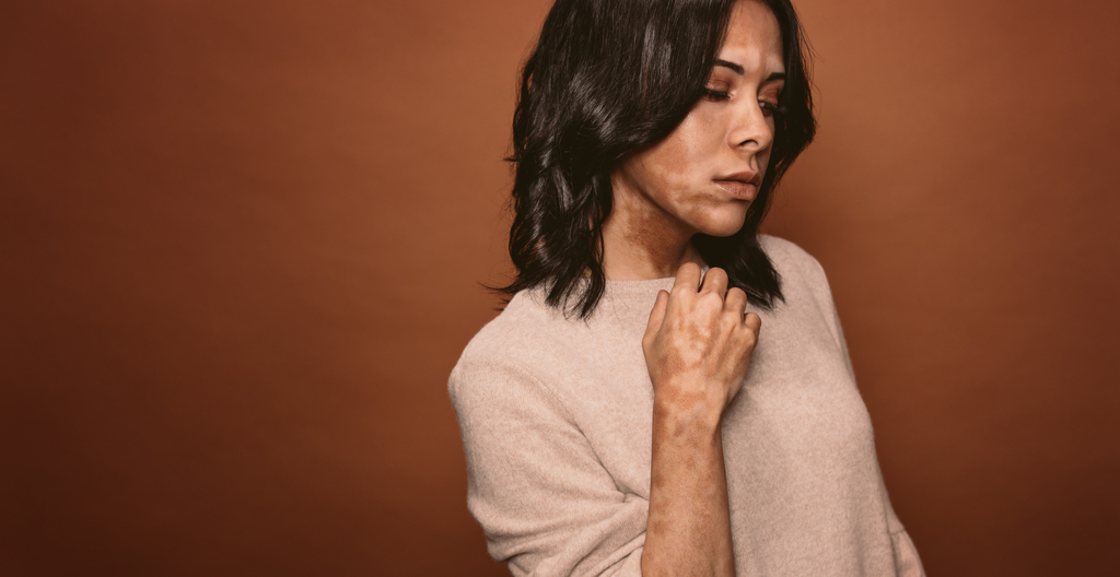 Woman with Vitiligo Signs Your Hair Will Go Gray