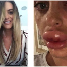 rachel knappier botox disaster