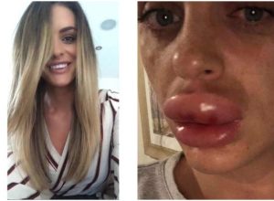 rachel knappier botox disaster