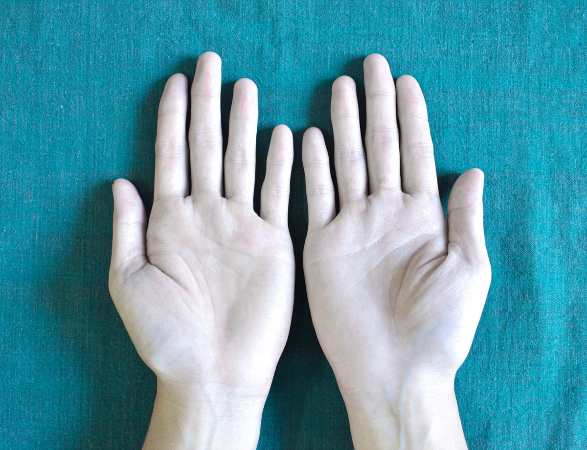 Pale hands anemic woman