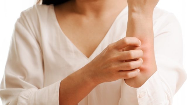 Woman Scratching a Rash on Her Arm {Allergy Symptoms}