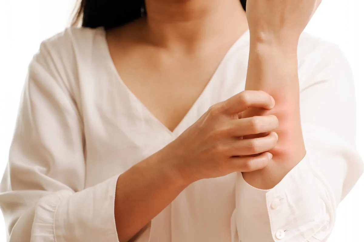 Woman scratching rash on her arm