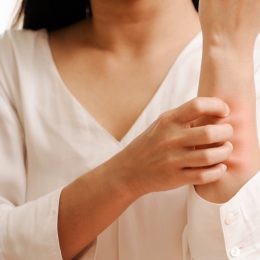 Woman Scratching a Rash on Her Arm {Allergy Symptoms}