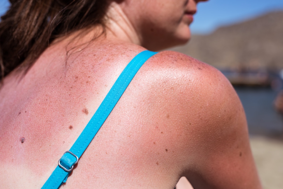 woman with sunburn on beach what happens to your body when you get a sunburn