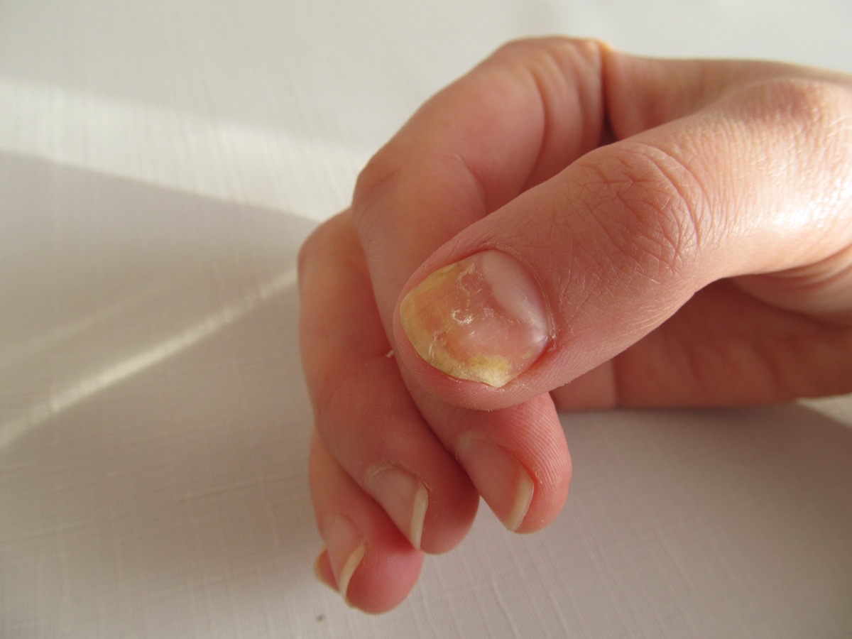 Hand foot and mouth disease - the aftermath! - Wondercare
