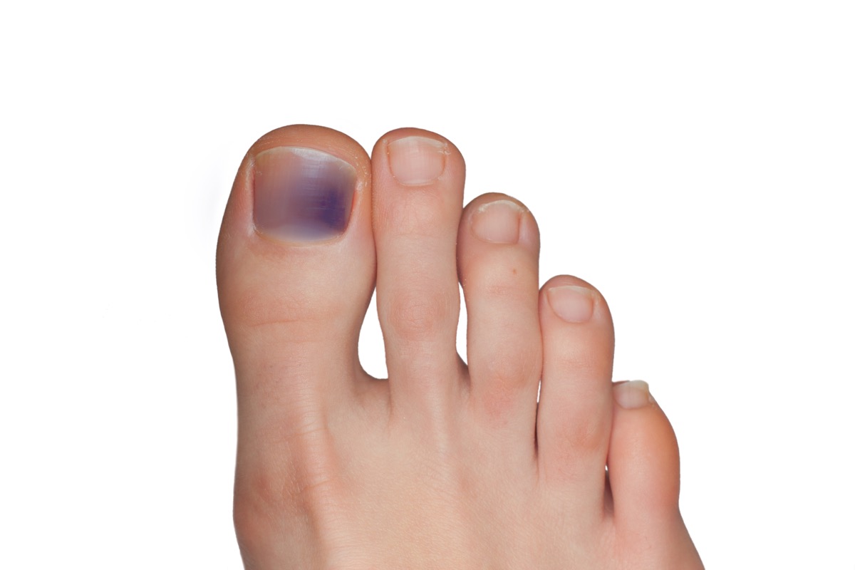 purple toenail unexpected signs your heart is unhealthy