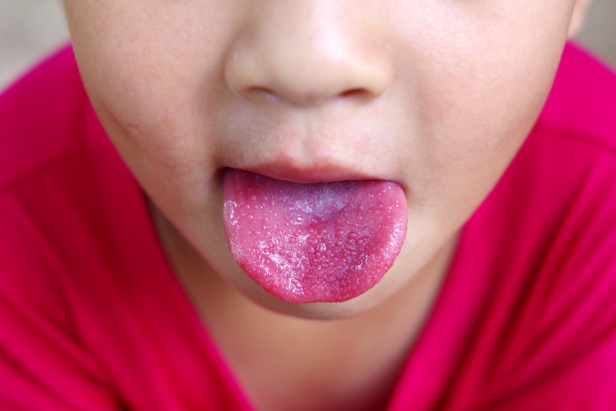 Scarlet Fever and Strawberry Tongue Tongue Health