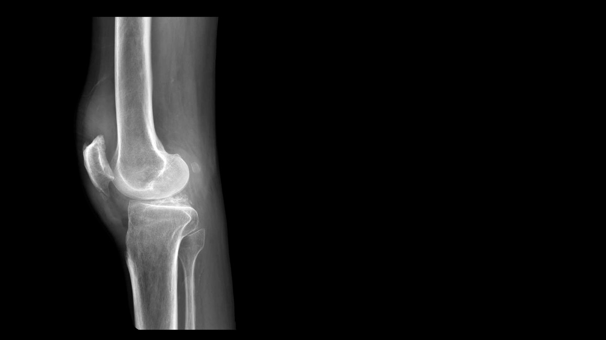 X-ray of a knee with a fabella