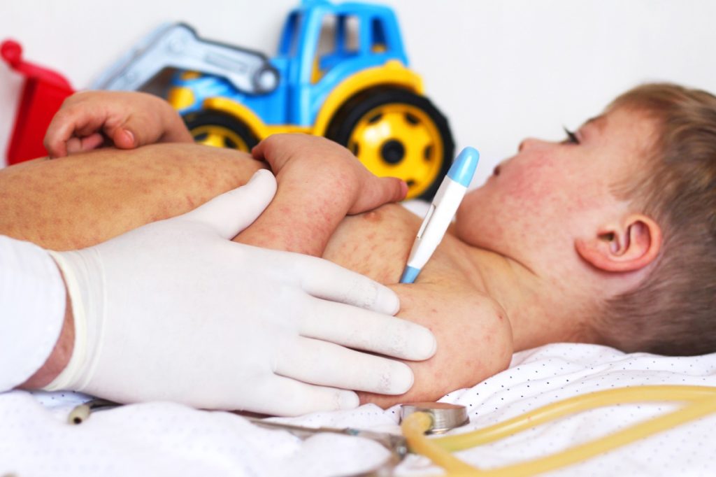 little boy with rash laying on bed while doctor takes his temperature under his arm