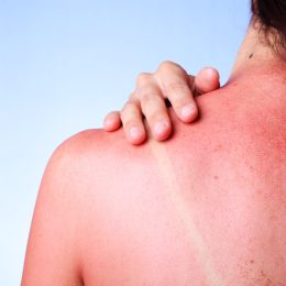 really bad sunburn, making sunburns worse
