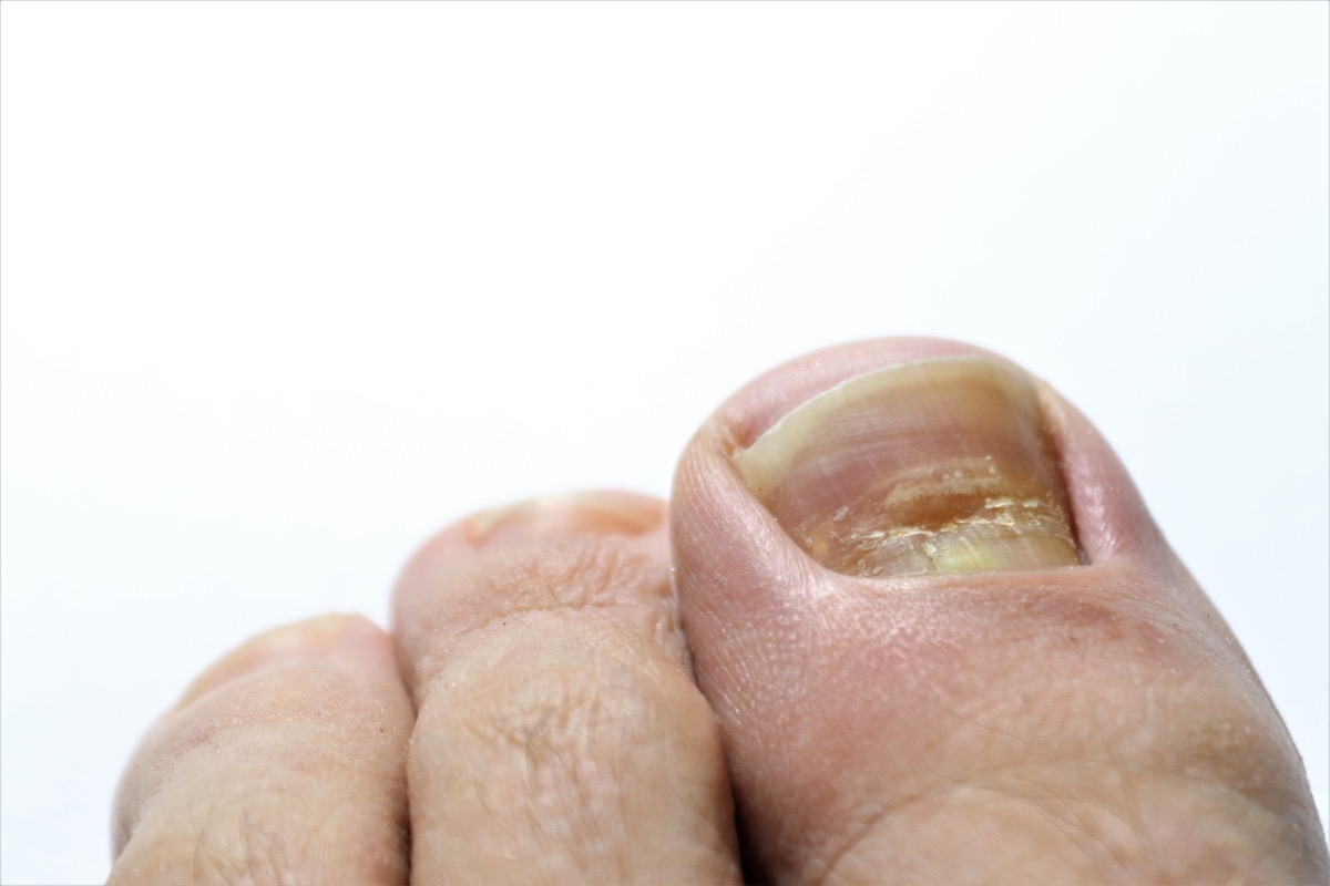 Brittle Nails - Relieve Foot Pain & Leg Pain