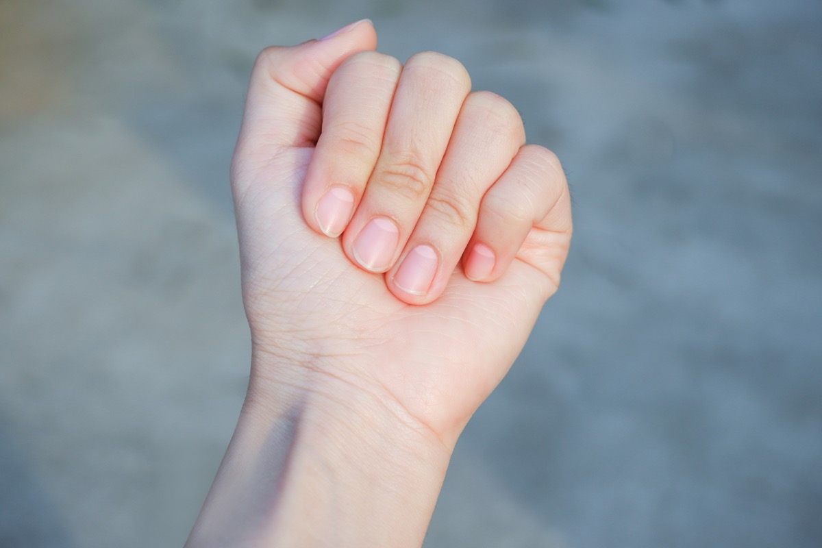 Half-and-half nails fingernail health