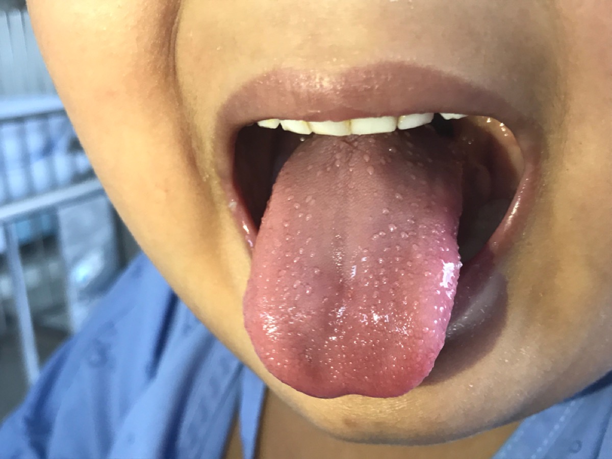 boy with spots on tongue, scarlet fever, contagious conditions