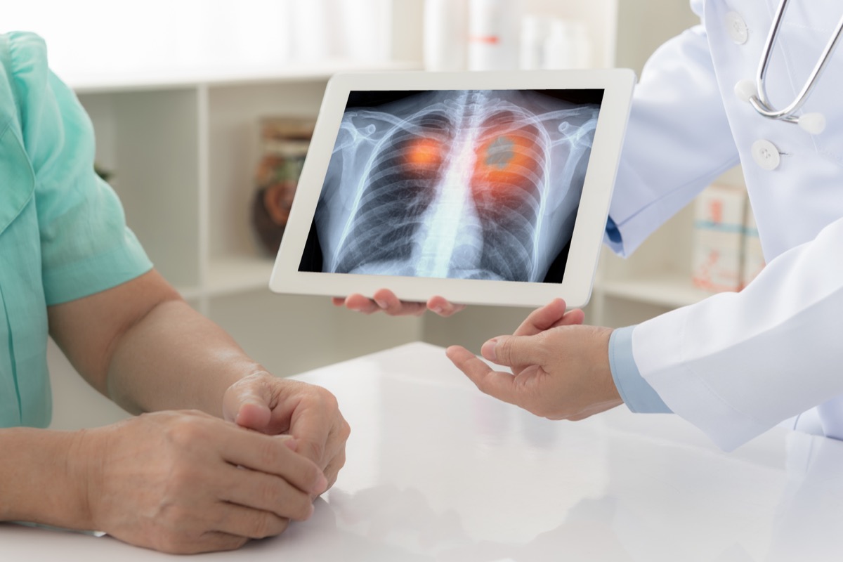 Рентгенова снимка на белите дробове