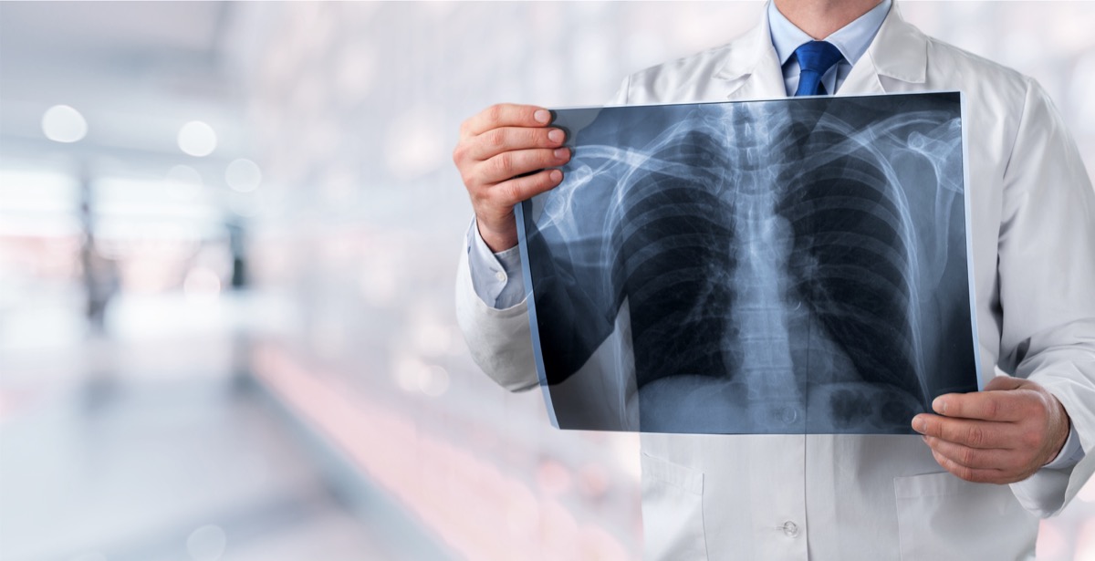 doctor holding up an x ray of lungs
