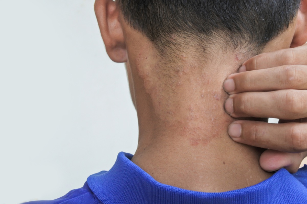 man scratching ringworm patch on neck, contagious conditions
