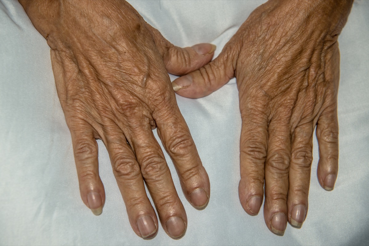 Ältere Frau mit kurvigen Nägeln Nagelgesundheit