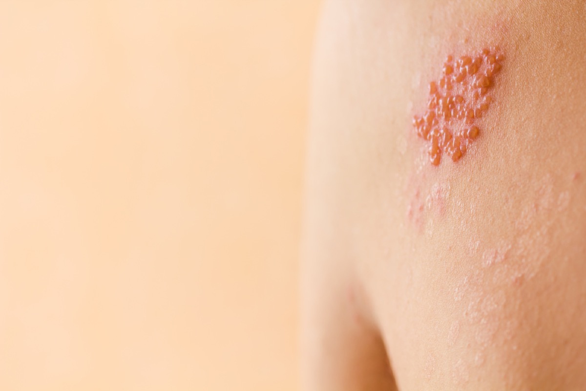 shingles rash on shoulder, contagious conditions