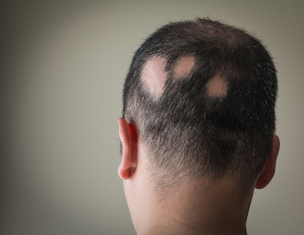 Man with alopecia